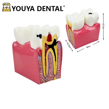 6-кратная модель сравнения кариеса, модель заболеваний зубов для студентов-стоматологов, обучающий модуль, изучающий демонстрационную практику.